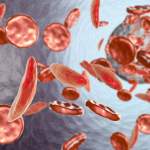 Sickle Cell Anemia