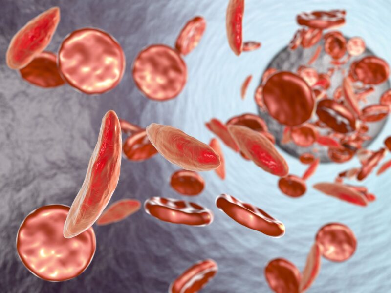 Sickle Cell Anemia