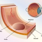 Stargardt Disease