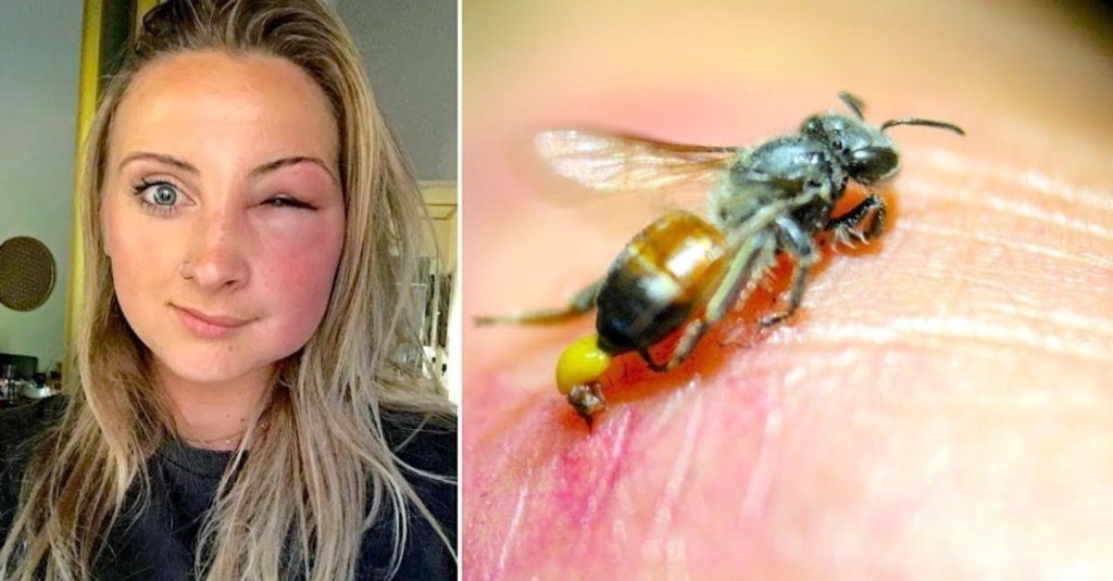 What Happens When a Bee Stings You: Complete Explanation for All Ages Bee Stings You