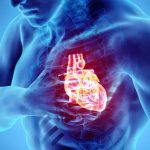 Cardiac Arrest