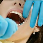 Removing wisdom teeth