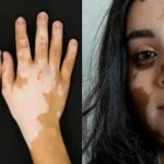 white patches on skin