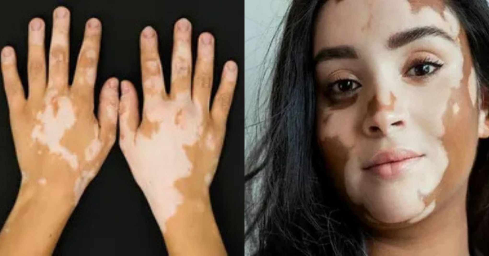 white patches on skin