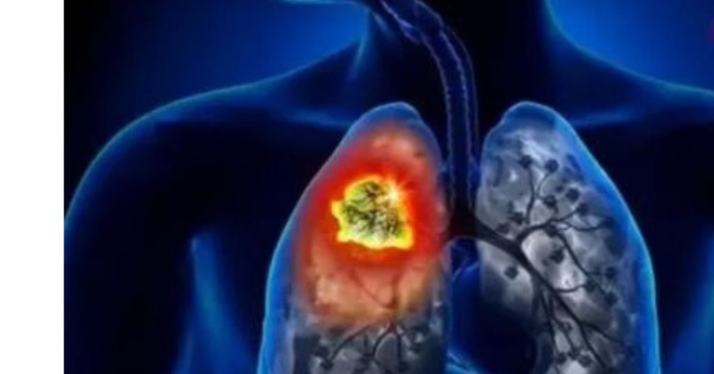 World Lung Cancer Day
