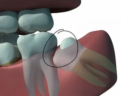 Removing Wisdom Teeth: A Complete Guide for Students and Adults Removing wisdom teeth