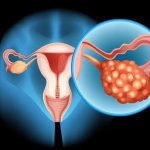 Symptoms of Ovarian Cancer