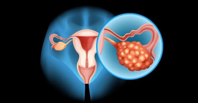 Symptoms of Ovarian Cancer