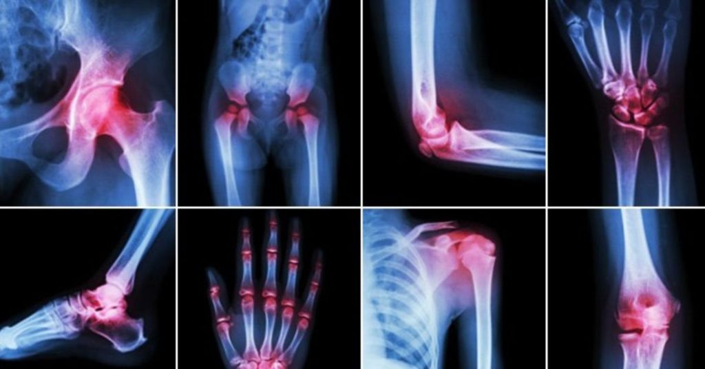 Arthritis: A Complete Guide to Understanding, Preventing, and Managing Joint Pain Arthritis