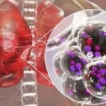 Understanding Legionnaires Disease