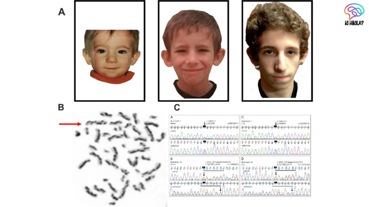 Bloom Syndrome: Rare Genetic Disorder Gains Medical Attention in India Bloom Syndrome