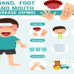 Hand, Foot and Mouth Disease Spread Among Children