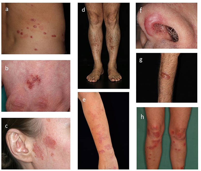 Sarcoidosis: Understanding the Complex Inflammatory Disease Affecting Multiple Organs Pretorius 188 Sarcoidosis