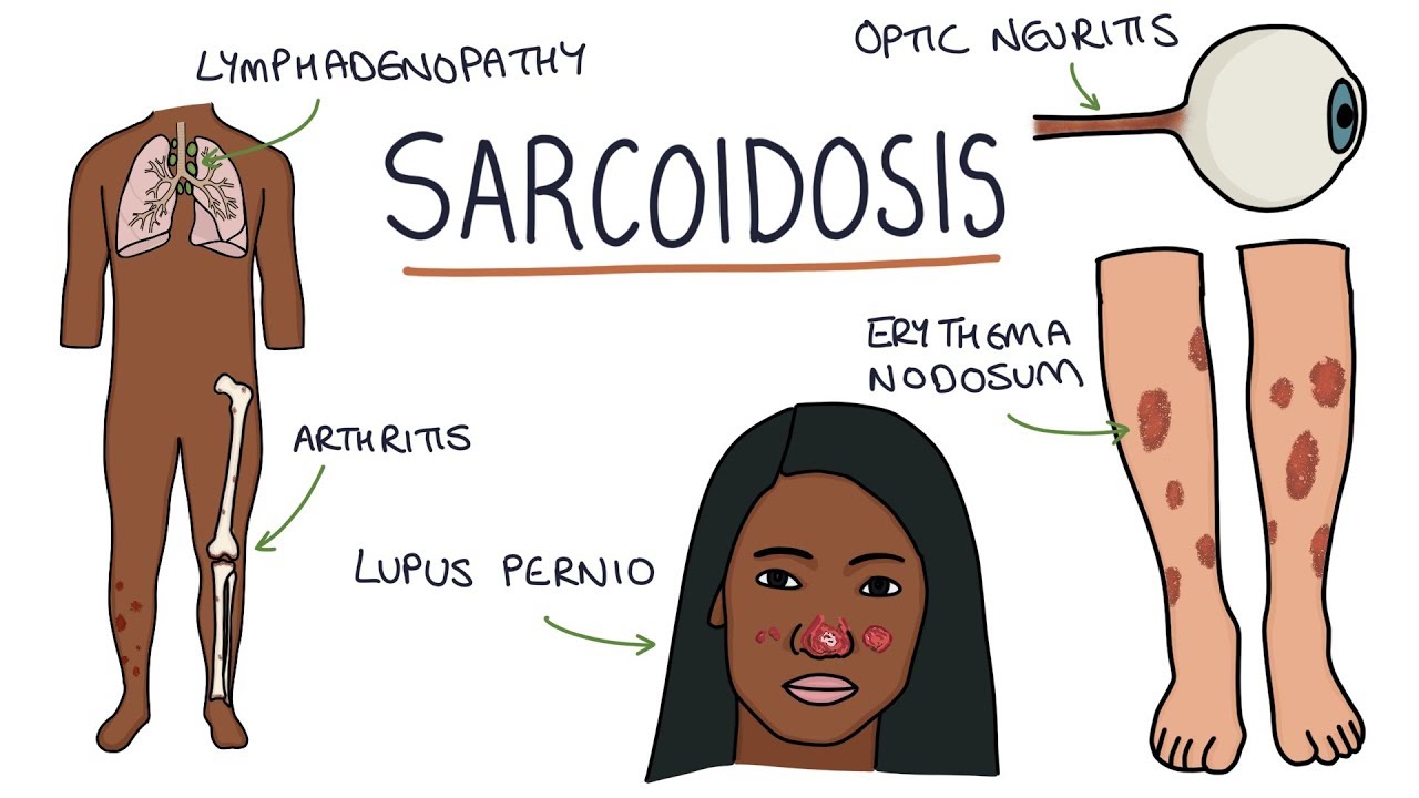 Sarcoidosis: Understanding the Complex Inflammatory Disease Affecting Multiple Organs Pretorius 188 Sarcoidosis