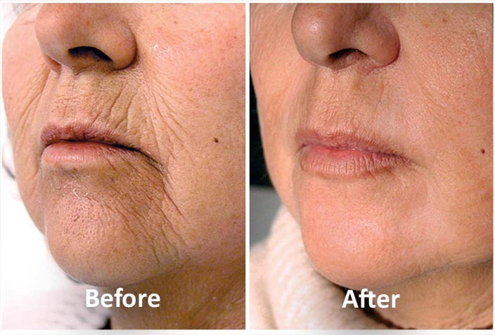 Laser Skin Tightening