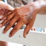 Maharashtra Leprosy Notifiable Disease