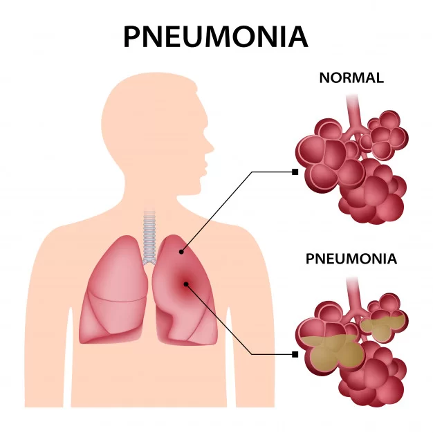 World Pneumonia Day