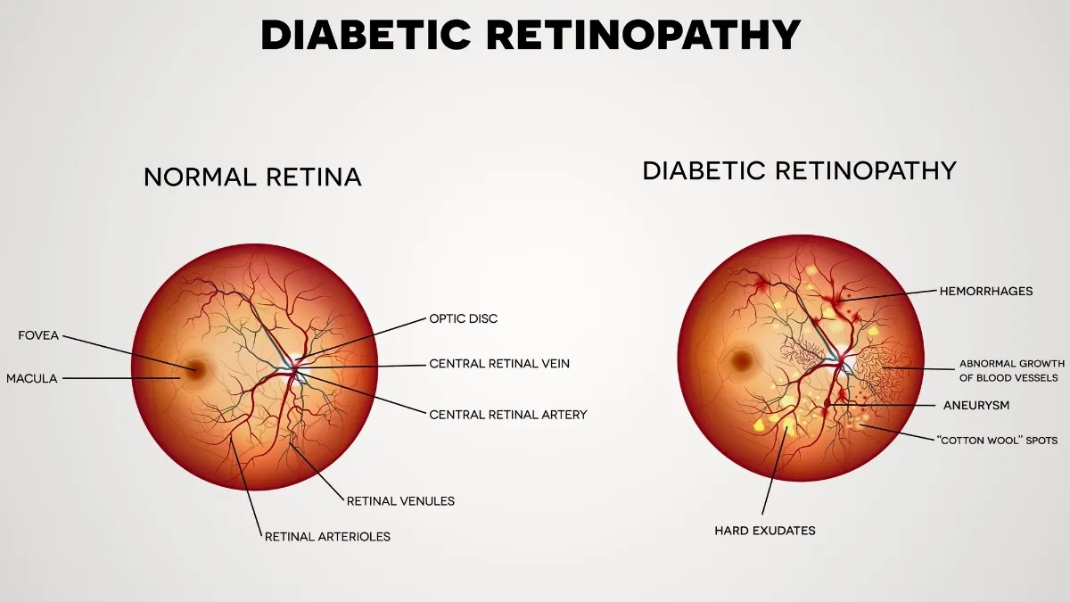 AI Diabetic Retinopathy Screening India