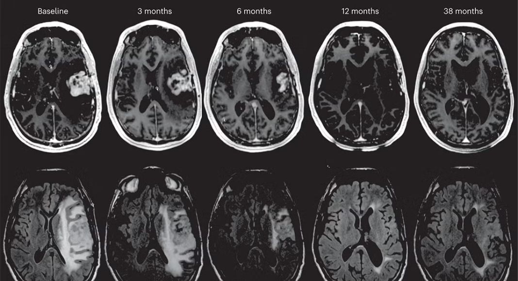 Glioblastoma Brain Cancer: Understanding the Disease Behind Sophie Kinsella’s Death Glioblastoma Brain Cancer