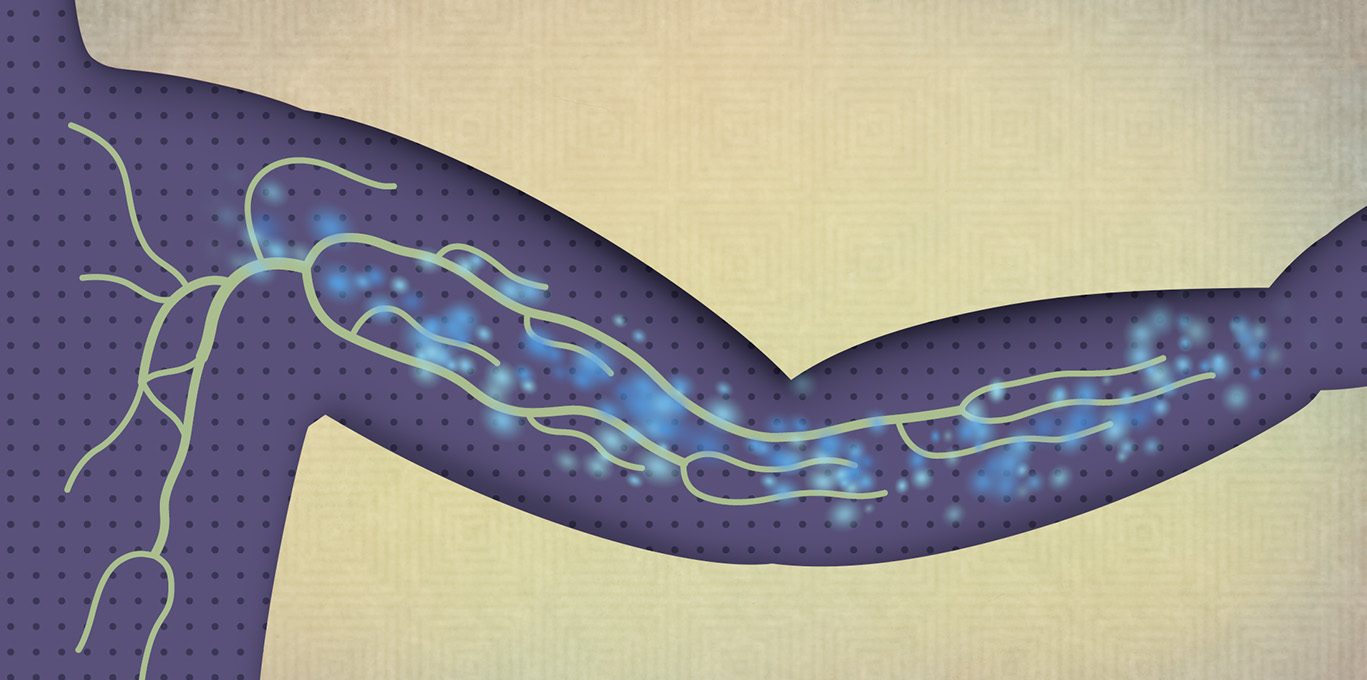 IGF Breakthrough for Lymphedema: New Hope for Treating a Chronic Swelling Disorder IGF Breakthrough for Lymphedema