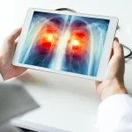 India Lung Cancer Guidelines