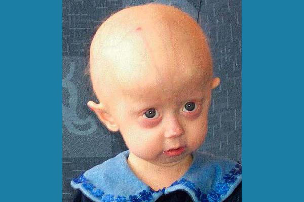 Progerinin Therapy Progeria