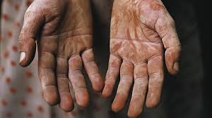 Chile Eliminates Leprosy WHO Verification: A Historic Public Health Achievement Chile Eliminates Leprosy WHO