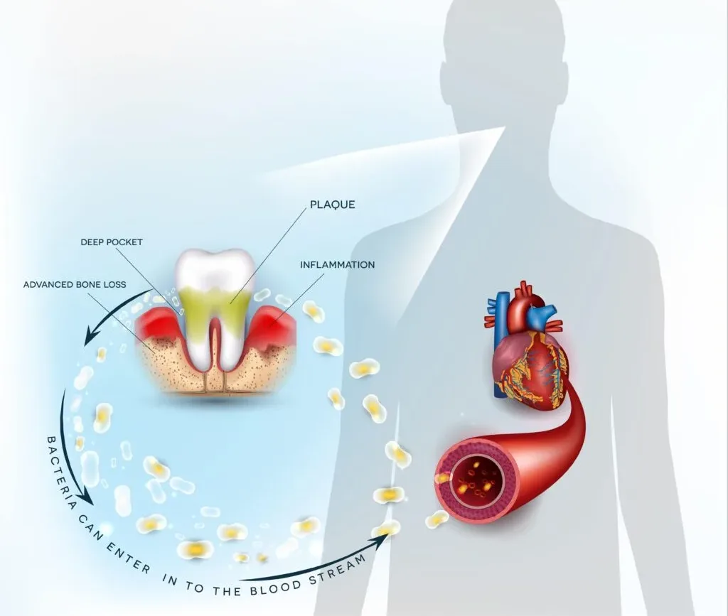 Oral Health Diabetes Heart Risk