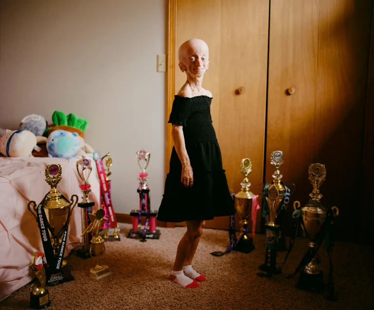 Progerinin Therapy Progeria